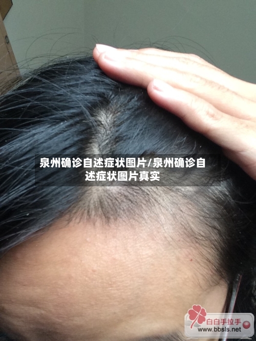 泉州确诊自述症状图片/泉州确诊自述症状图片真实