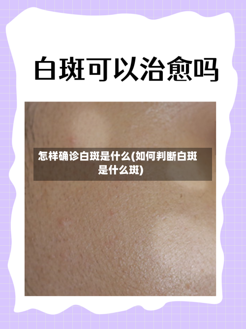 怎样确诊白斑是什么(如何判断白斑是什么斑)