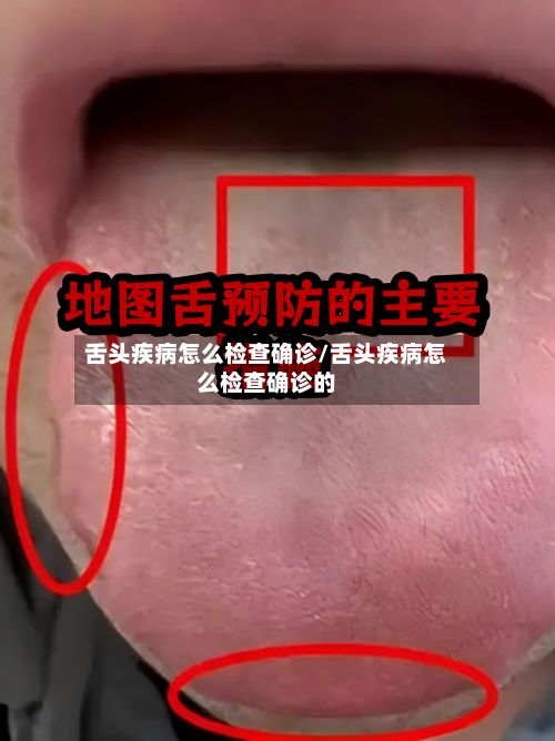 舌头疾病怎么检查确诊/舌头疾病怎么检查确诊的